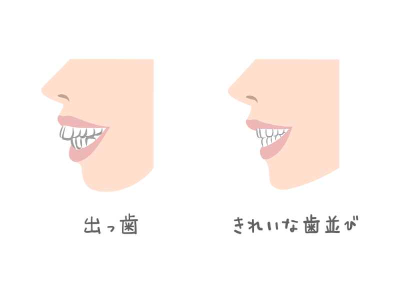 出っ歯と綺麗な歯並び