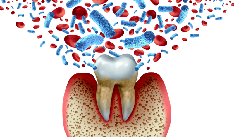 歯周病の原因となる細菌のイメージ
